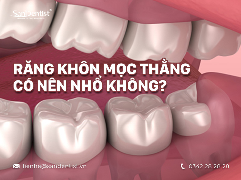 Răng khôn mọc thẳng có nên nhổ không? [TÌM HIỂU NGAY]