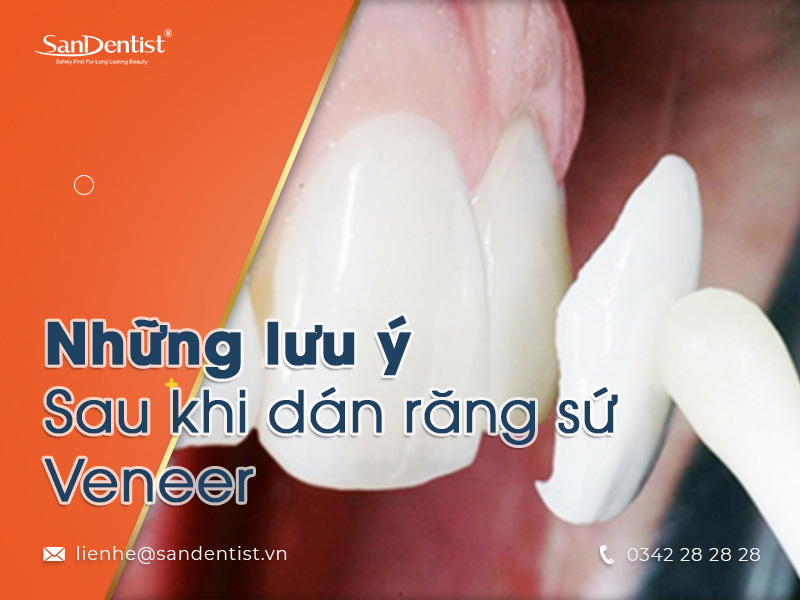 Dán răng sứ veneer có thực sự tốt?