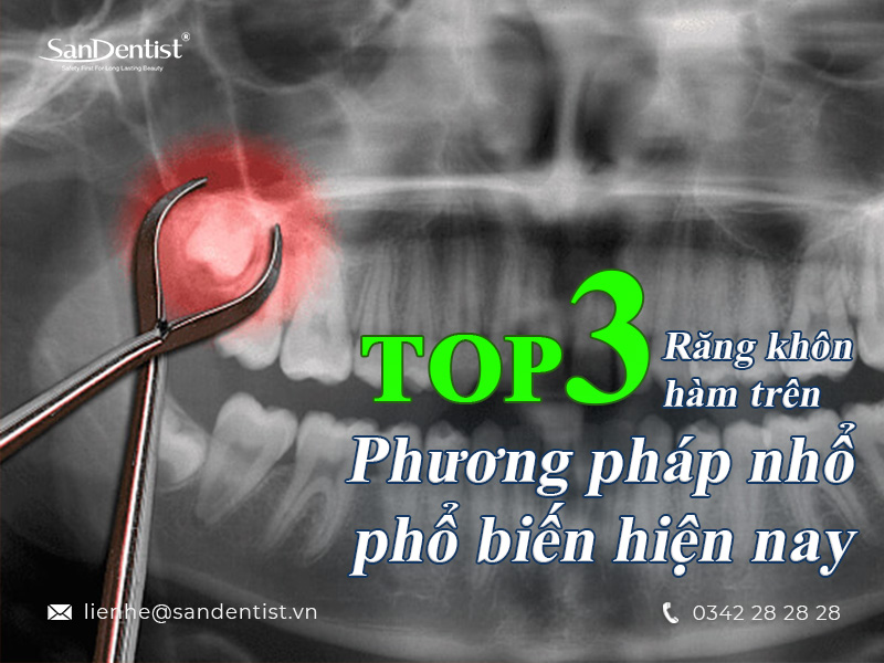 TOP 3 phương pháp nhổ răng khôn hàm trên phổ biến hiện nay!