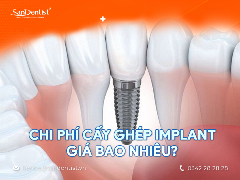 Cấy ghép Implant giá rẻ ở đâu tại TPHCM?