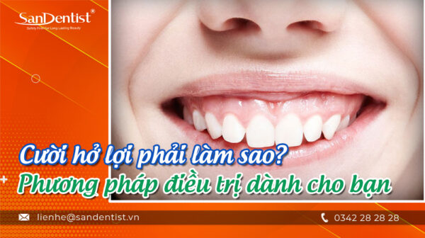Cười hở lợi phải làm sao? Phương pháp điều trị dành cho bạn