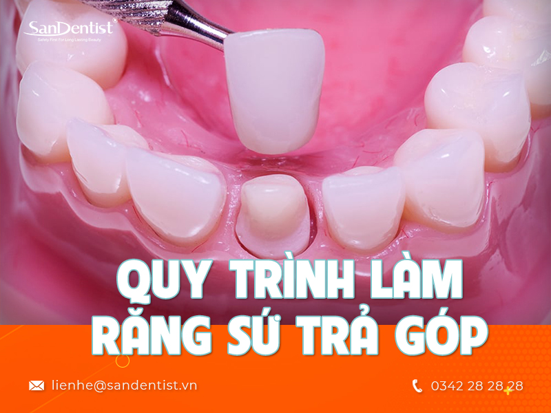 Dịch vụ làm răng sứ trả góp có gì phức tạp không?