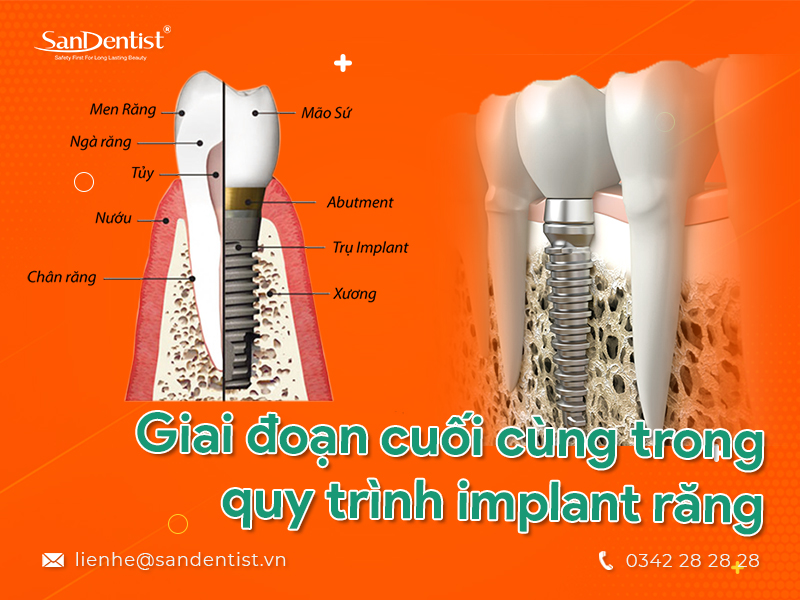 Quy trình implant răng được thực hiện qua những giai đoạn nào?