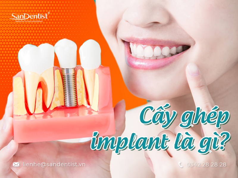 Implant là gì? Những ưu và nhược điểm khi cấy ghép răng implant