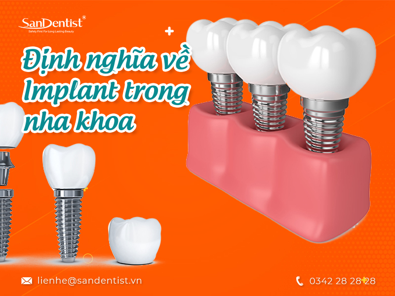 Tìm hiểu Implant loại nào tốt