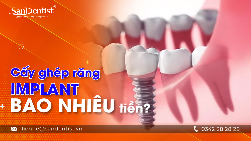 Cấy ghép răng implant bao nhiêu tiền?