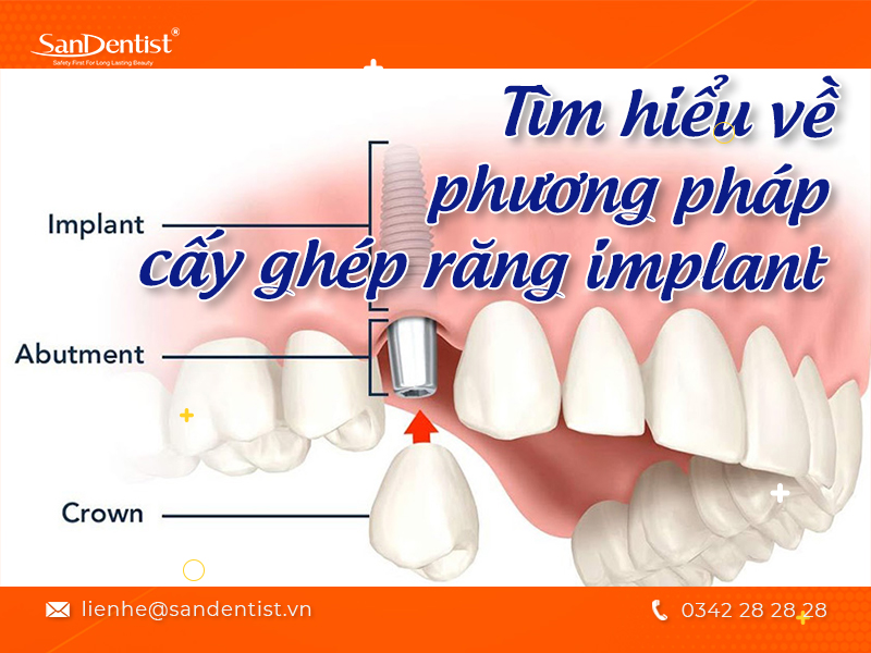 Cấy ghép răng implant mất bao lâu?