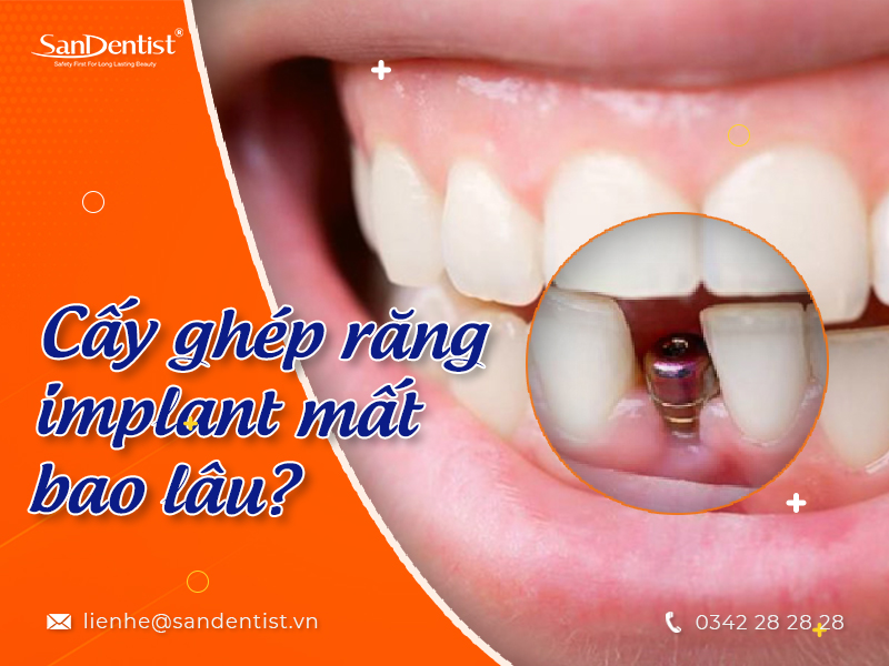 Cấy ghép răng implant mất bao lâu?