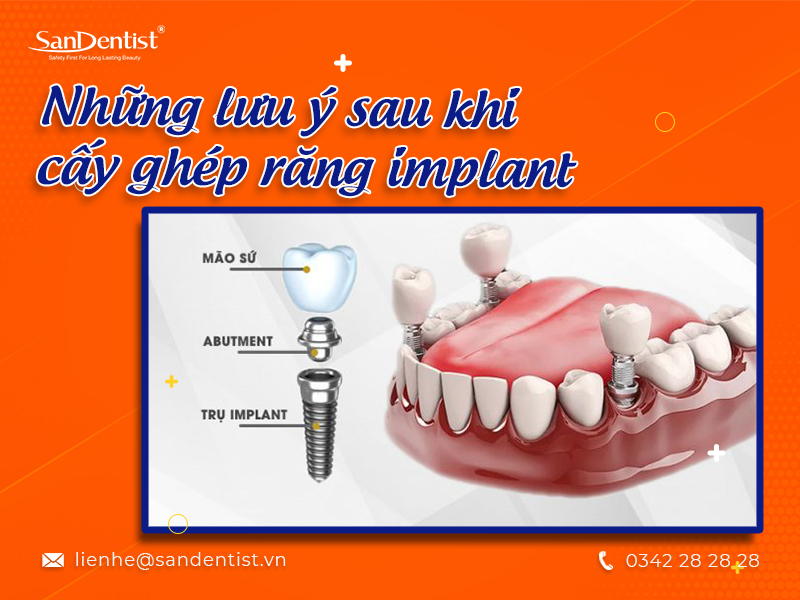Cấy ghép răng implant mất bao lâu?