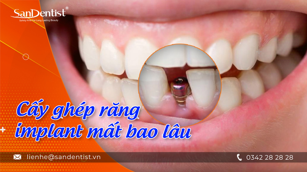 Cấy ghép răng implant mất bao lâu?