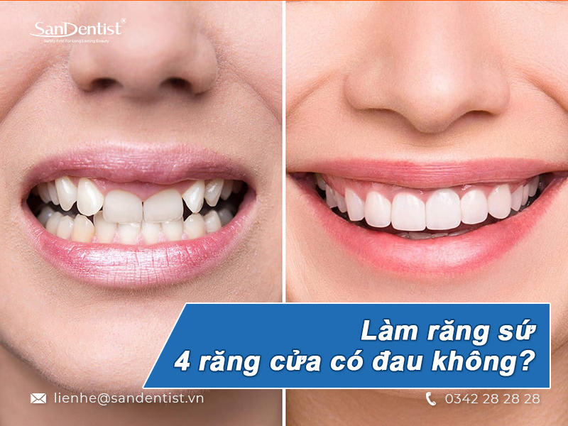 Có nên làm răng sứ 4 răng cửa không?