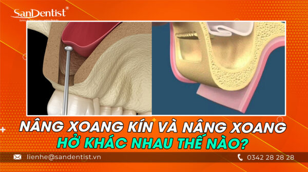 Nâng xoang kín và nâng xoang hở khác nhau thế nào?
