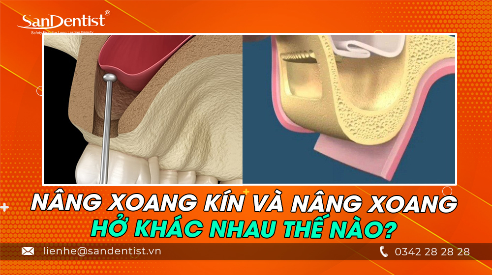 Nâng xoang kín và nâng xoang hở khác nhau thế nào?