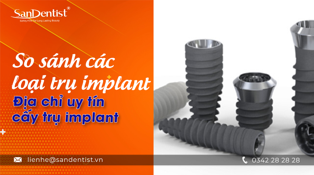 So sánh các loại trụ implant – Địa chỉ uy tín cấy trụ implant