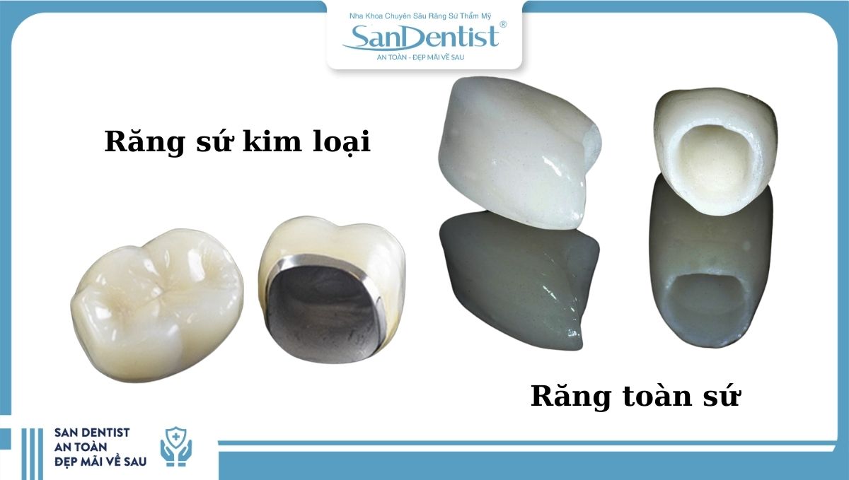 Răng sứ kim loại và toàn sứ có gì khác nhau