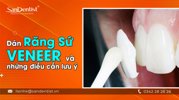 Dán răng sứ Veneer và những điều cần lưu ý