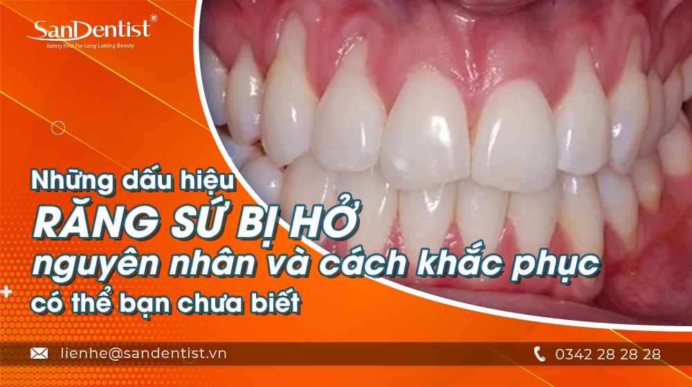 Những dấu hiệu răng sứ bị hở, nguyên nhân và cách khắc phục có thể bạn chưa biết