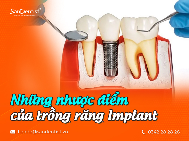 Những nhược điểm của trồng răng Implant mà bạn cần phải lưu ý!