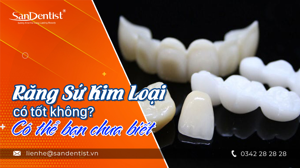 Răng sứ kim loại có tốt không? Có thể bạn chưa biết