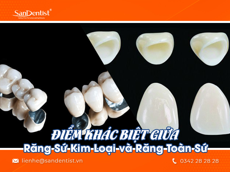 Răng sứ kim loại và răng toàn sứ khác nhau điểm nào?