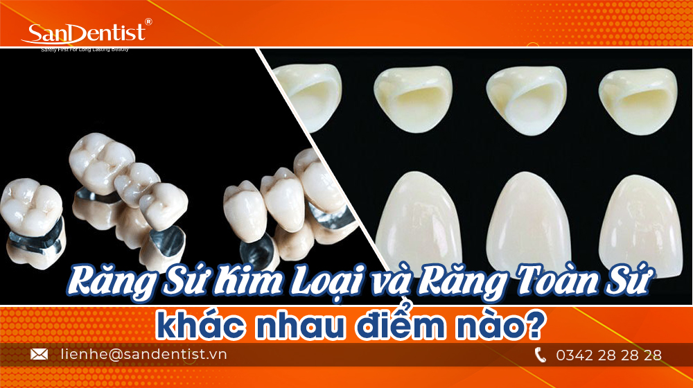 Răng sứ kim loại và răng toàn sứ khác nhau điểm nào?