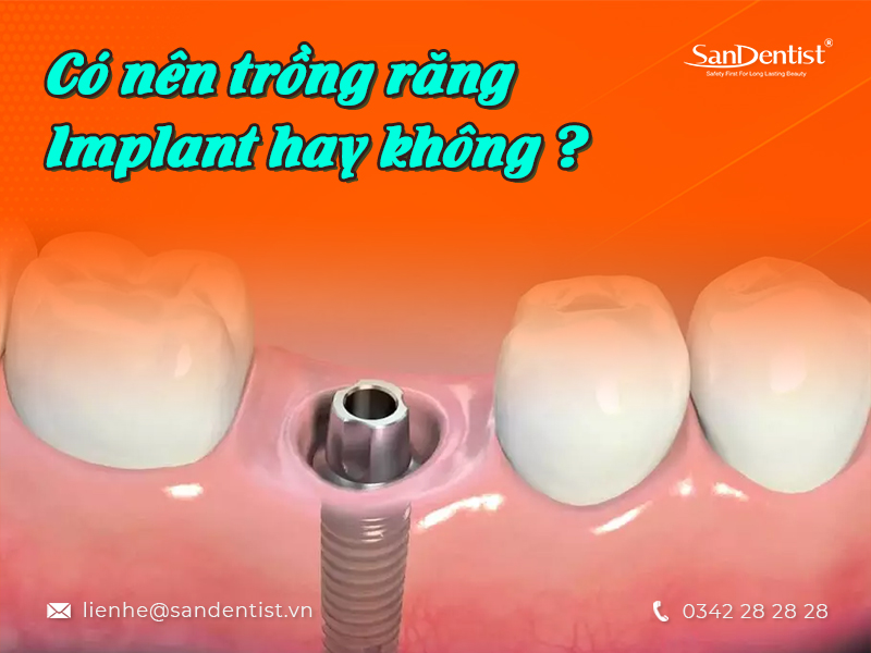 Theo bạn có nên trồng răng Implant hay không?
