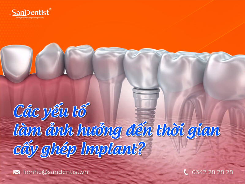 thời gian cấy ghép implant sẽ được kéo dài trong bao lâu?