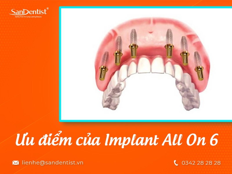 Tìm hiểu về phương pháp cấy ghép implant all on 6