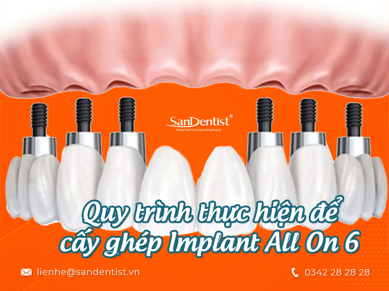 Tìm hiểu về phương pháp cấy ghép implant all on 6