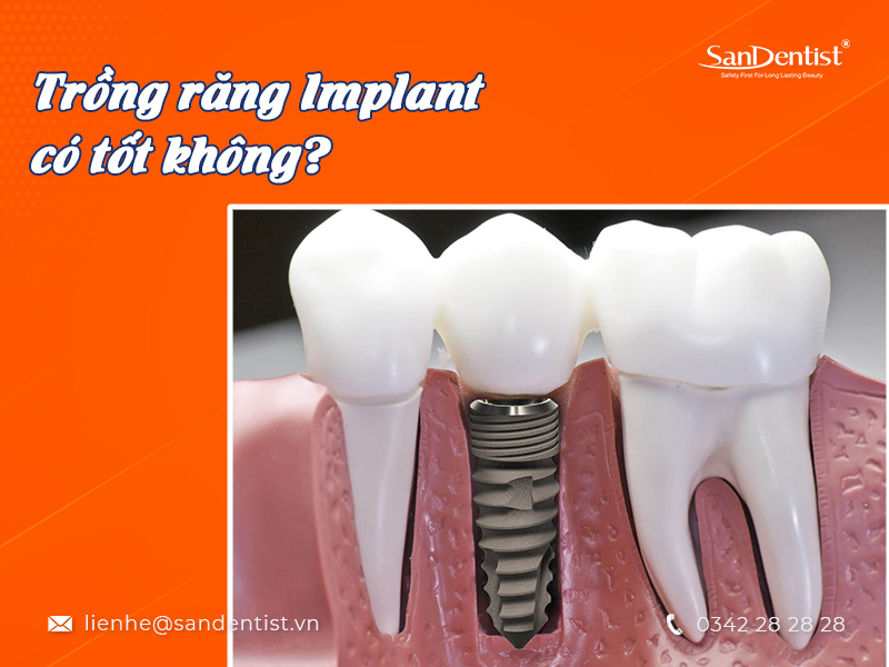 Trồng răng Implant có tốt không?