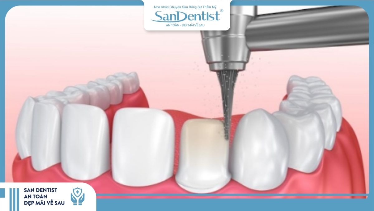 Một số lưu ý trước và sau khi mài răng để bọc sứ