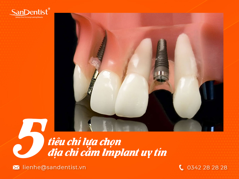 Cắm Implant ở đâu tốt? 5 tiêu chí lựa chọn địa chỉ làm răng Implant uy tín 