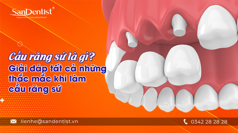 Cầu răng sứ là gì? Giải đáp tất cả những thắc mắc khi làm cầu răng sứ