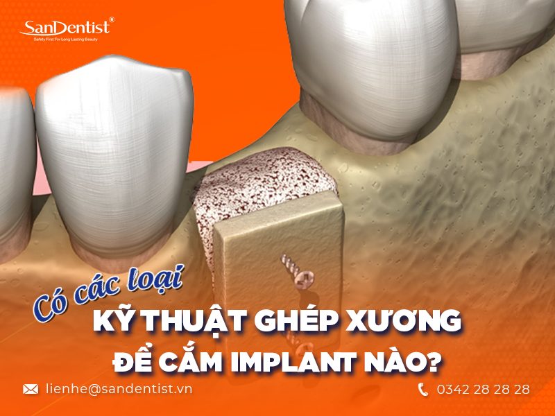 Cấy ghép xương để cắm Implant có mắc không?