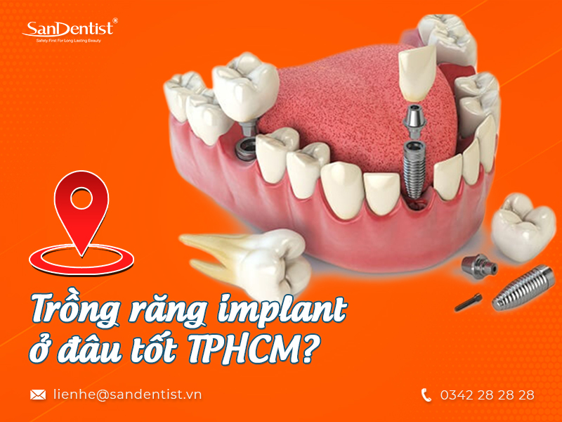 Địa chỉ trồng răng Implant ở đâu tốt TPHCM?