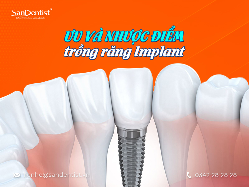 Địa chỉ trồng răng Implant ở đâu tốt TPHCM?