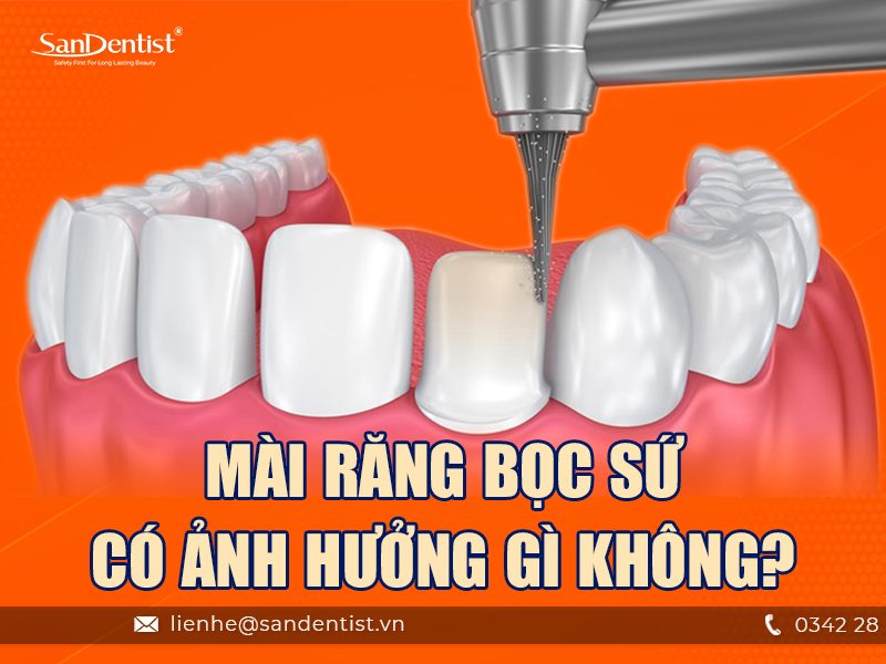 Mài răng bọc sứ có ảnh hưởng gì không? Tại sao phải thực hiện mài răng khi bọc sứ?