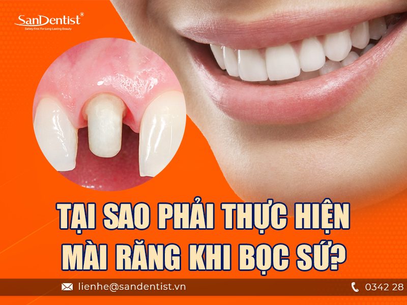 Mài răng bọc sứ có ảnh hưởng gì không? Tại sao phải thực hiện mài răng khi bọc sứ?