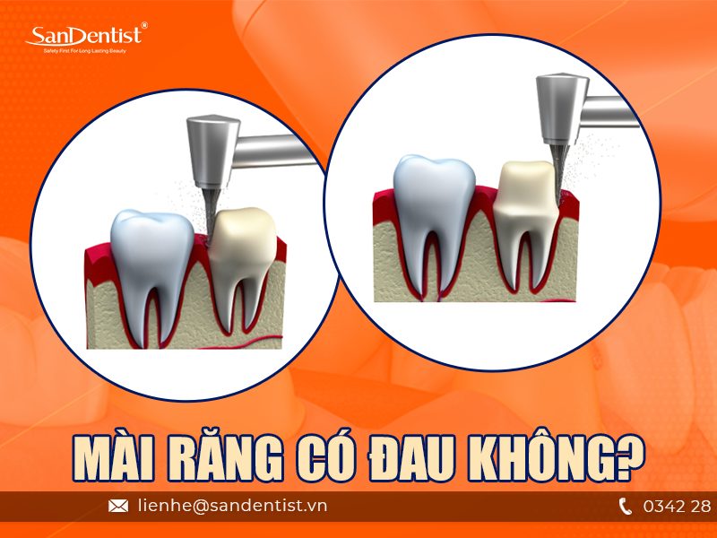 Mài răng bọc sứ có ảnh hưởng gì không? Tại sao phải thực hiện mài răng khi bọc sứ?