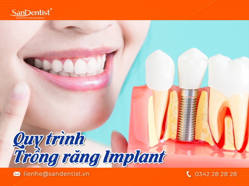 Quy trình trồng răng Implant đạt chuẩn nha khoa