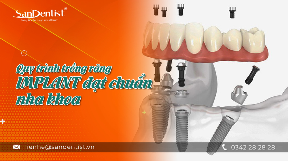 Quy trình trồng răng Implant đạt chuẩn nha khoa