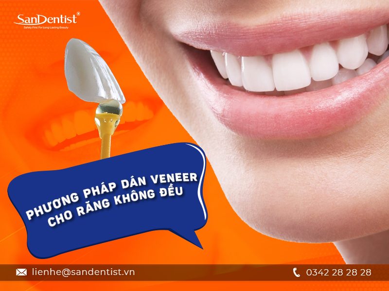 Răng không đều có dán sứ được không? Phương pháp được ưa chuộng hiện nay