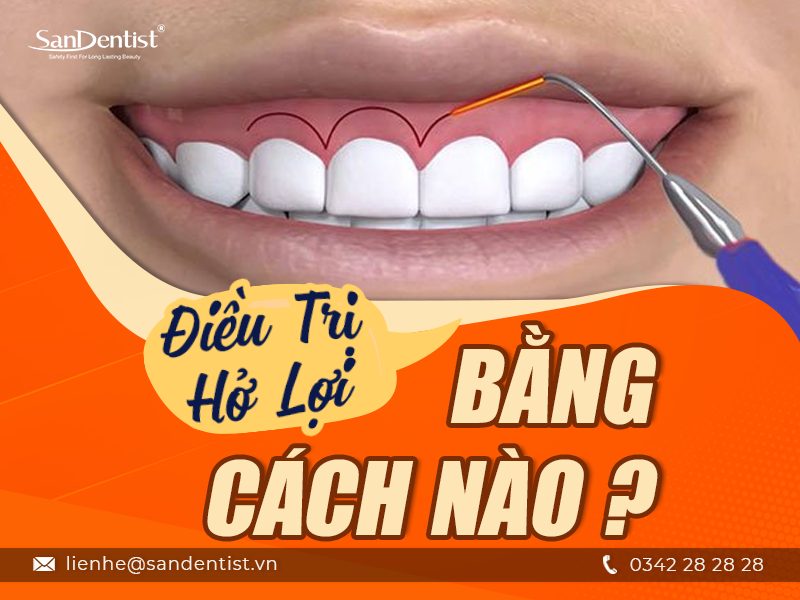 Điều trị hở lợi bằng cách nào và quy trình điều trị hở lợi