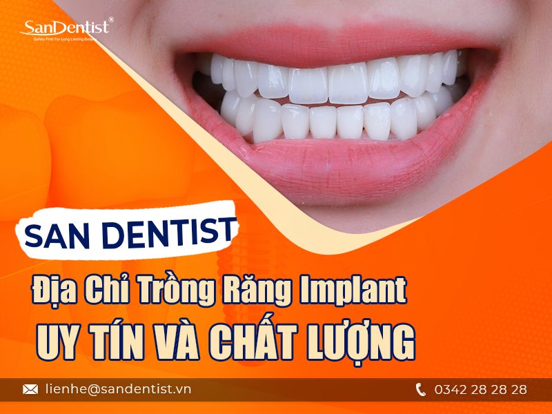 Kinh nghiệm làm răng Implant từ A-Z không phải ai cũng biết