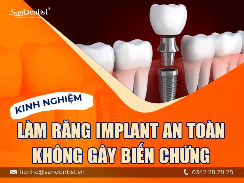 Kinh nghiệm làm răng Implant từ A-Z không phải ai cũng biết