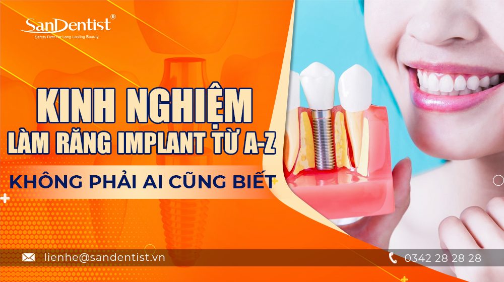 Kinh nghiệm làm răng Implant từ A-Z không phải ai cũng biết