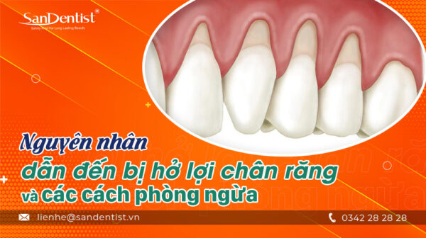 Nguyên nhân dẫn đến bị hở lợi chân răng và các cách phòng ngừa