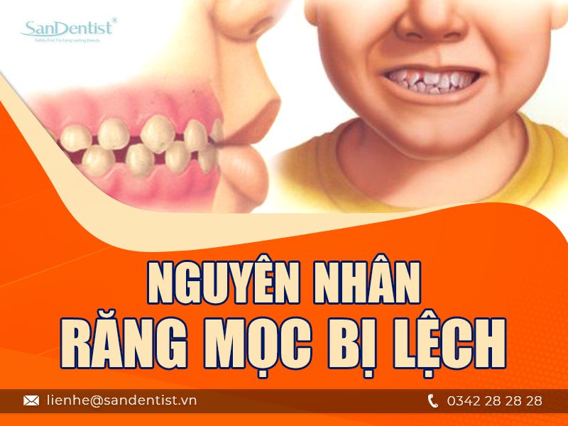 Răng mọc lệch có nên trồng răng sứ không?