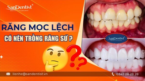 Răng mọc lệch có nên trồng răng sứ không?