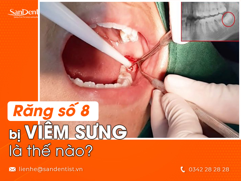 Răng số 8 bị viêm - Nguyên nhân và cách điều trị